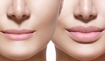 estetiksiz-dudak-dolgunlastirmak